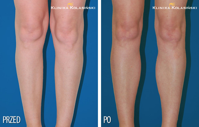 Pictures before and after: Calf correction