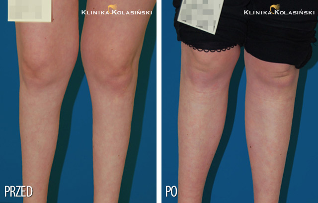 Pictures before and after: Calf correction