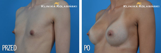 Bilder vorher und nachher: Bruststraffung
