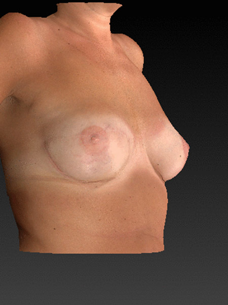 Rekonstrukcja piersi przy pomocy przeszczepu własnego tłuszczu