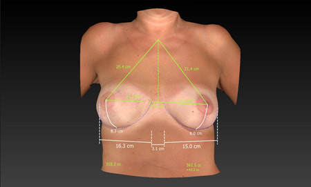 Analiza przy pomocy aparatu Vectra 3D wykazuje bardzo zbliżone parametry piersi zrekonstruowanej do piersi zdrowej