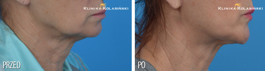Zdjęcia przed i po: face lift twarzy