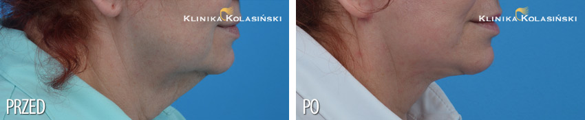 Zdjęcia przed i po: face lift twarzy