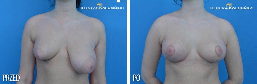 Zdjęcia przed i po: podniesienie piersi