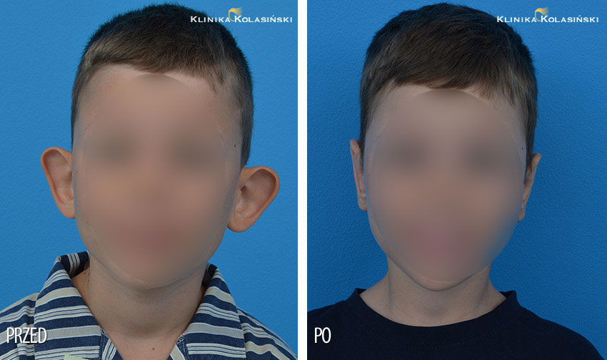 Zdjęcia przed i po zabiegu: korekcji uszu