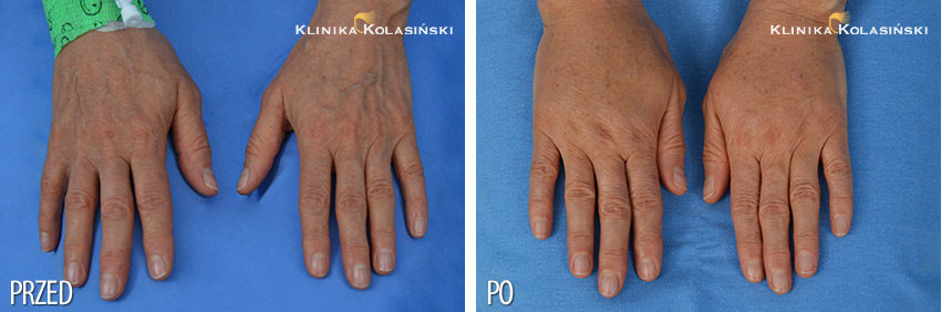 Pacjent przed i po zabiegu przeszczepu tkanki tłuszczowej na dłonie