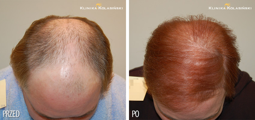 Kobieta lat 60 z przerzedzeniem okolicy ciemieniowej głowy Stan przed zabiegiem przeszczepu włosów i po nim.