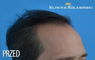 Proces łysienia u mężczyzn najczęściej rozpoczyna się w okolicy czołowej, tworząc charakterystyczna zakola. Stan przed leczeniem.