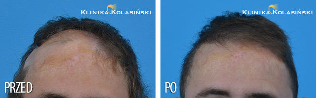 Przeszczep włosów u dzieci - zdjęcia przed i po