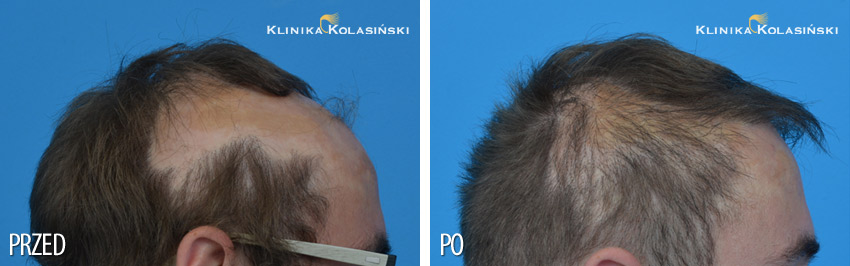 Pictures before and after: hair transplantation in children