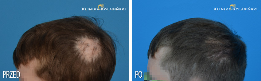 Przeszczep włosów u dzieci - zdjęcia przed i po