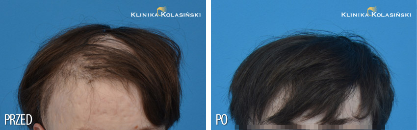 Pictures before and after: hair transplantation in children