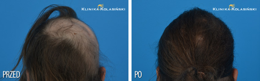 Bilder vorher und nachher: Haartransplantationen bei Kindern