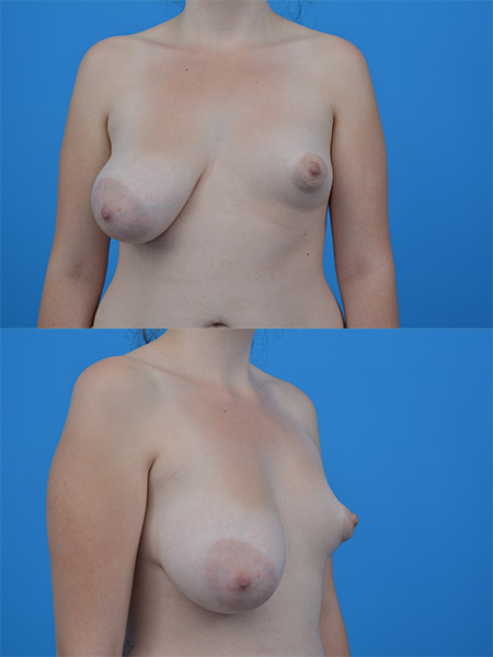Pierś tubularna po str lewej z przerostem piersi prawej. Celem operacji jest korekcja piersi tubularnej i podniesienie z redukcją piersi prawej