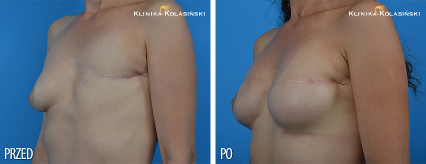 Rekonstrukcja piersi - Klinika Kolasiński