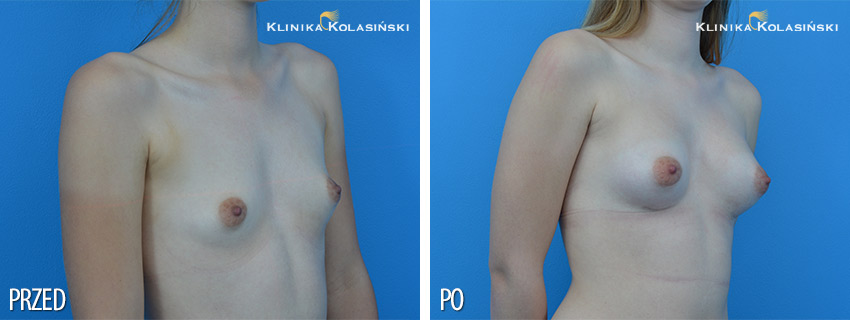 Korekcja nietypowych piersi - Klinika Kolasiński