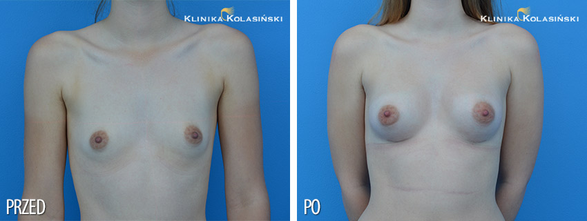 Korekcja nietypowych piersi - Klinika Kolasiński