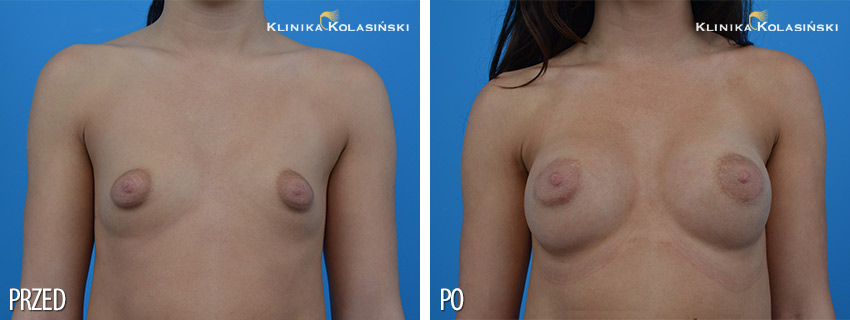 Powiększenie piersi tubularnych - Klinika Kolasiński