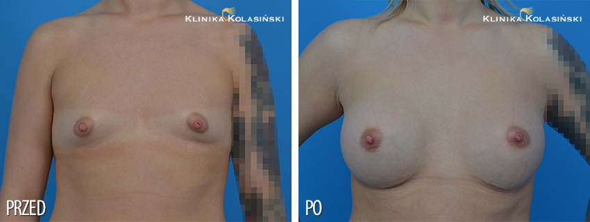 Powiększenie piersi tubularnych - Klinika Kolasiński