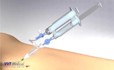 ScleroSafe TM