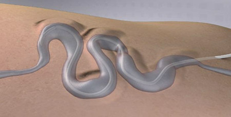 ScleroSafe TM