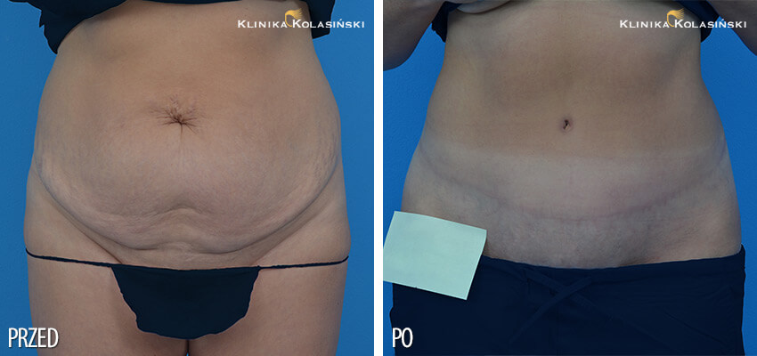 Zdjęcia przed i po: abdominoplastyka