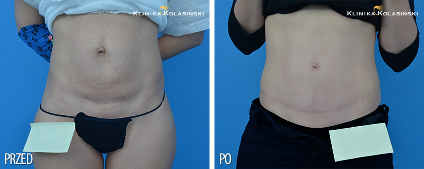 Pictures before and after: Abdominoplasty