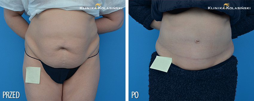 Bilder vorher und nachher: Abdominoplastik