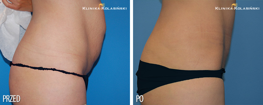 Zdjęcia przed i po: abdominoplastyka
