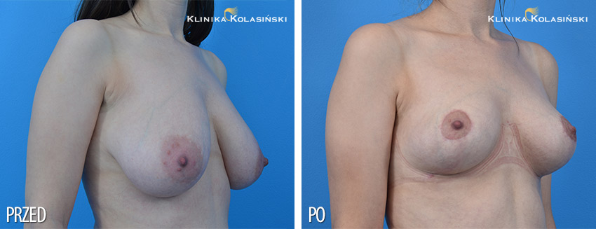Zdjęcia przed i po: podniesienie piersi
