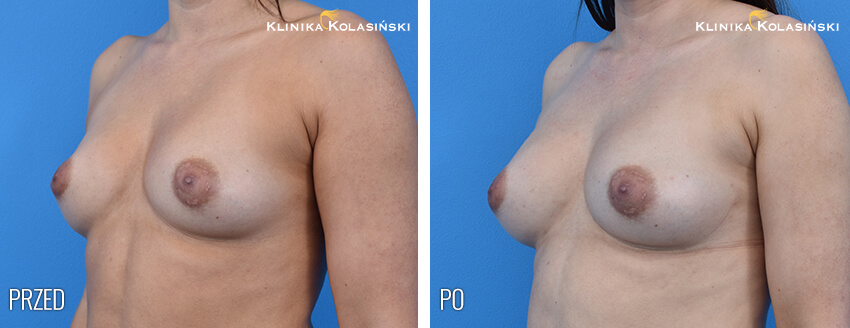 Zdjęcia przed i po: Lipoplastyka piersi