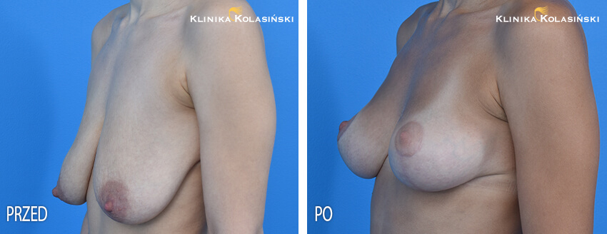 Podniesienie piersi - Klinika Kolasiński