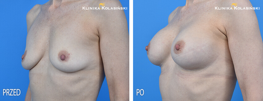 Powiększanie piersi - Klinika Kolasiński