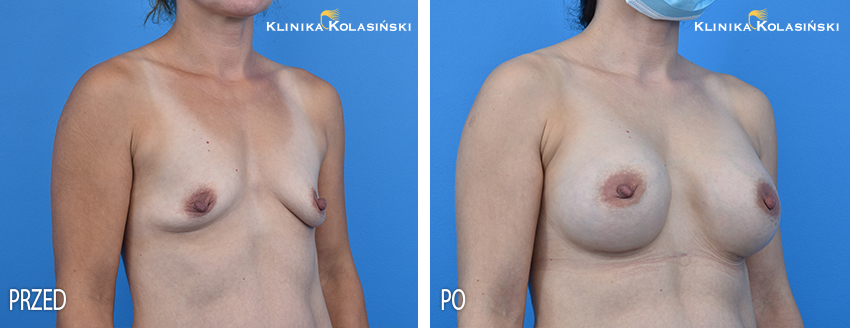 Powiększanie piersi - Klinika Kolasiński