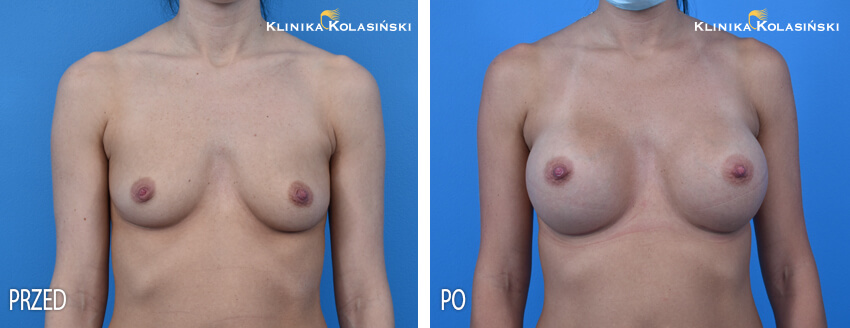 Zdjęcia przed i po: Podpowięziowe powiększanie piersi