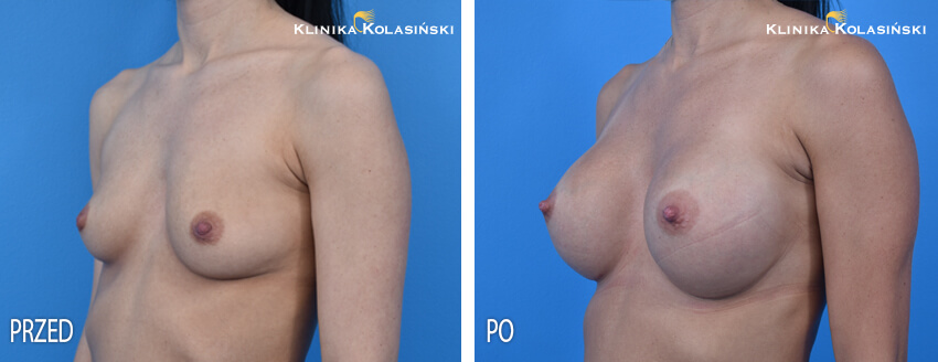 Zdjęcia przed i po: Podpowięziowe powiększanie piersi