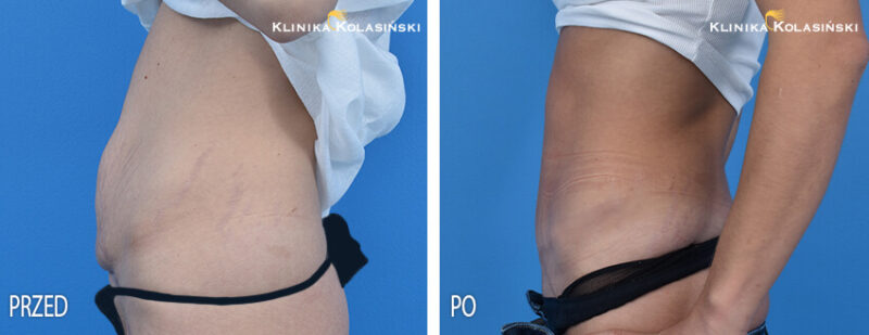 Abdominoplastyka - zdjęcia przed i po - Klinika Kolasiński