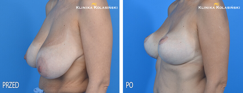 Redukcja piersi - Klinika Kolasiński