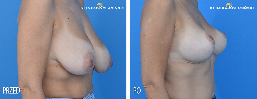 Redukcja piersi - Klinika Kolasiński