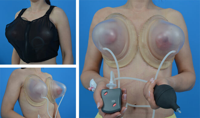Przygotowanie piersi przy pomocy aparatu próżniowego